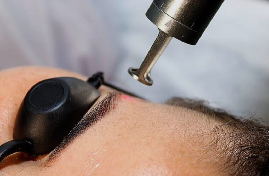 Despigmentação a Laser de Micropigmentação