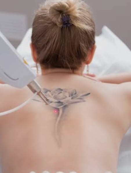 Remoção de Tatuagem a Laser